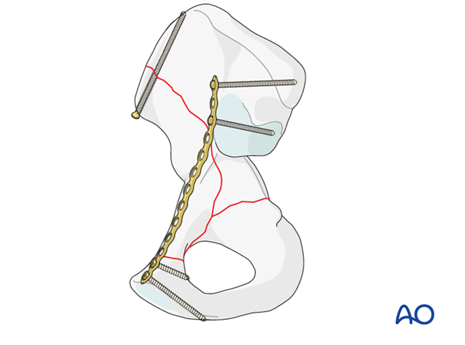 ORIF through ilioinguinal approach for Anterior column and posterior ...