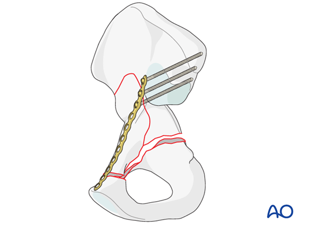 orif through modified stoppa approach