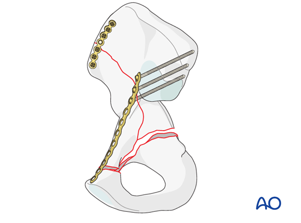 orif through modified stoppa approach