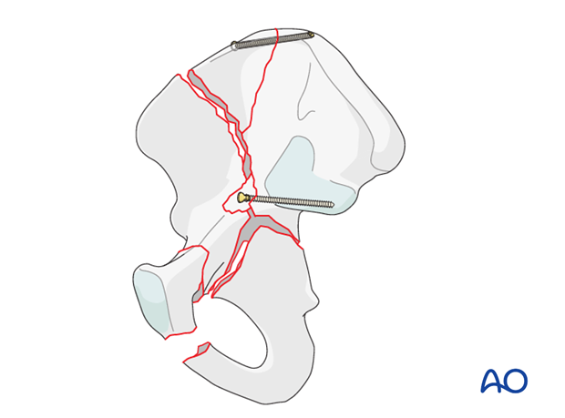 orif through ilioinguinal approach