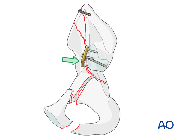 orif through ilioinguinal approach