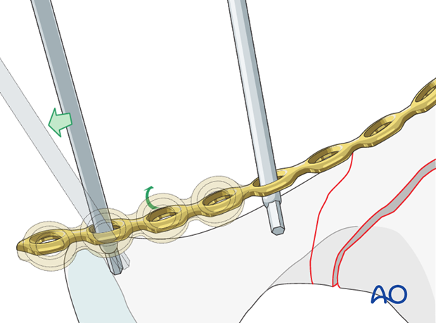 orif through modified stoppa approach