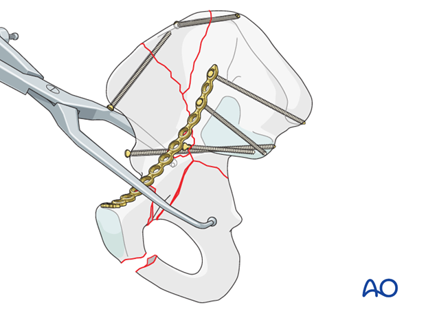 orif through ilioinguinal approach