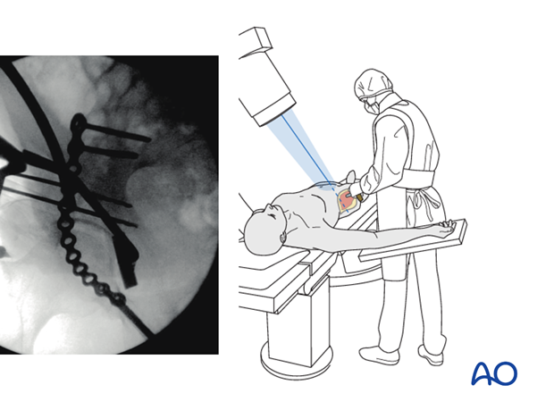 orif through ilioinguinal approach