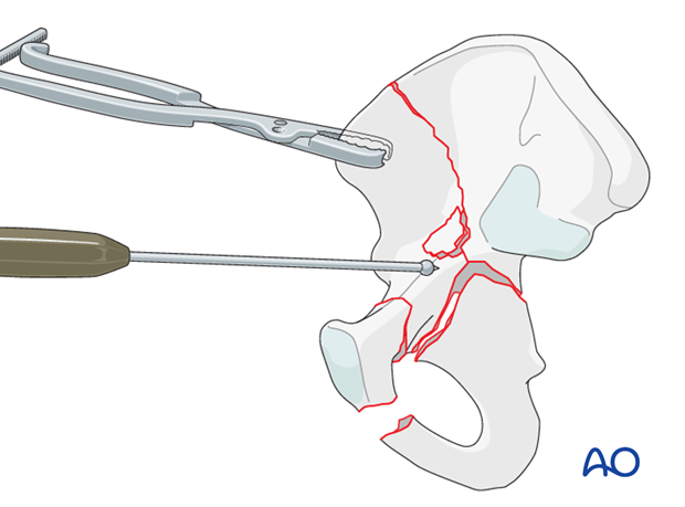 orif through modified stoppa approach