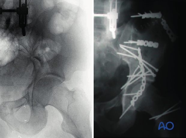 orif through extended iliofemoral approach