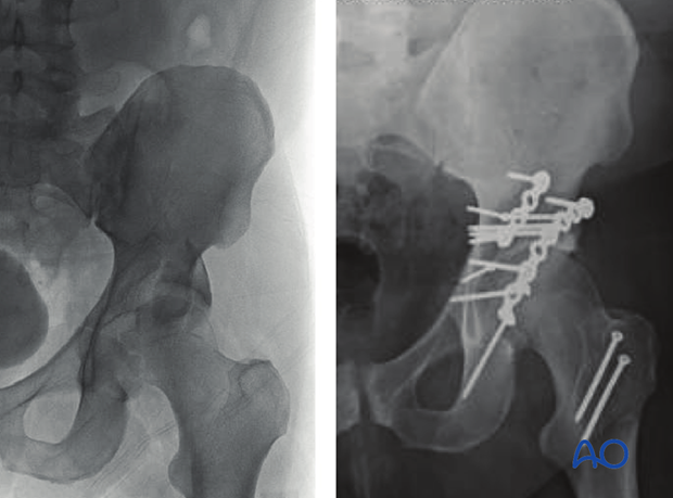 orif through trochanter osteotomy extension