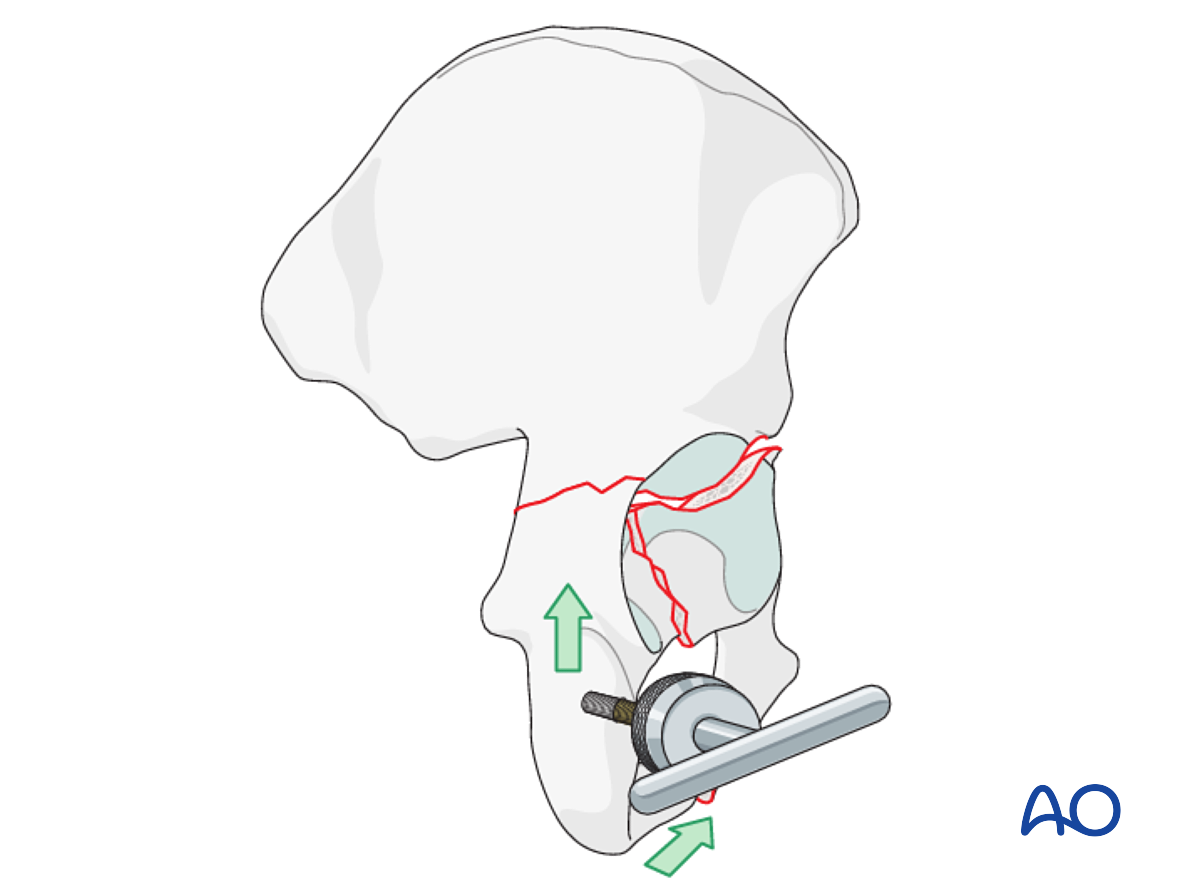 ORIF Through Extended Iliofemoral Approach For T-type