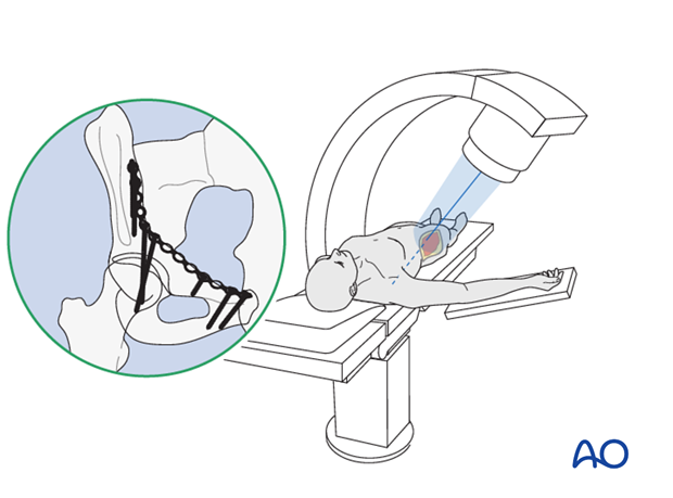 orif through ilioinguinal approach