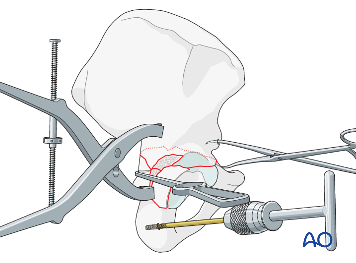 ORIF Through Extended Iliofemoral Approach For Transverse And Posterior ...