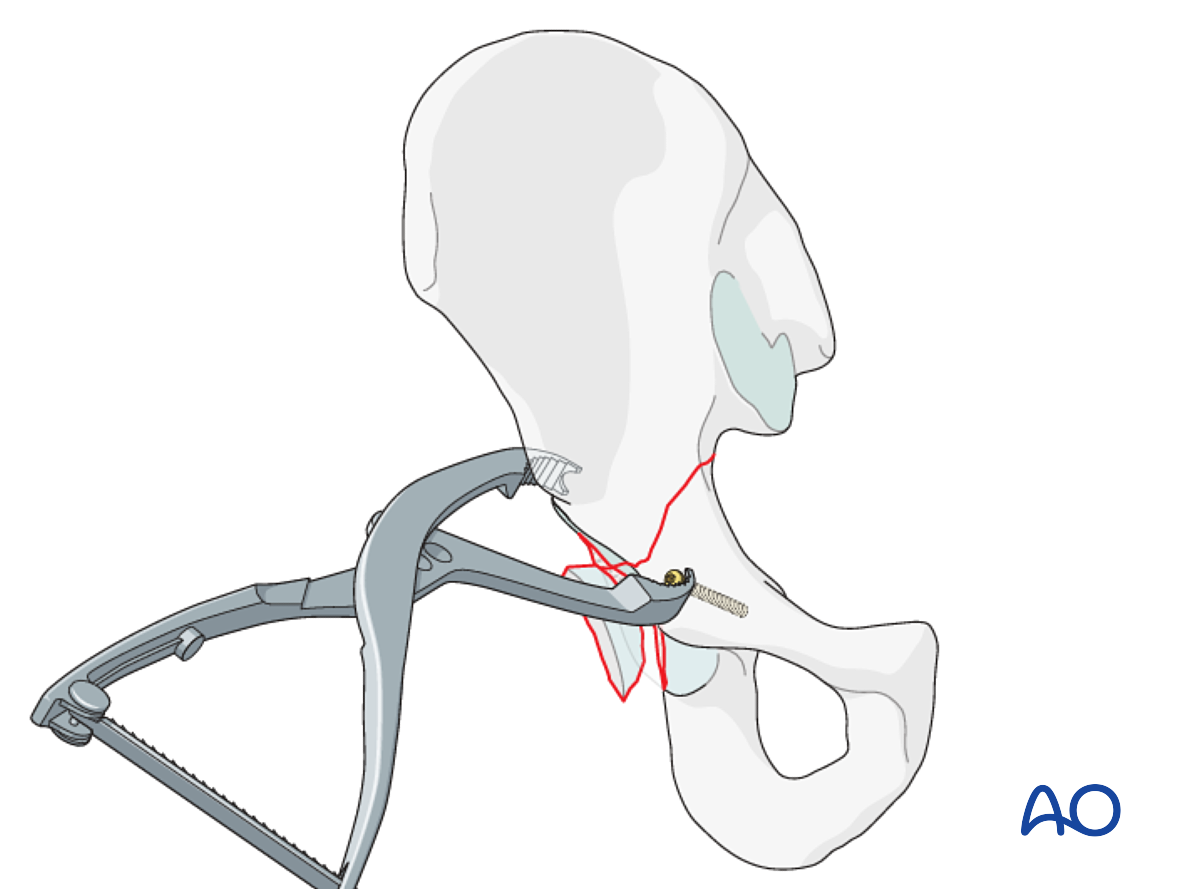 ORIF Through Extended Iliofemoral Approach For Transverse And Posterior ...