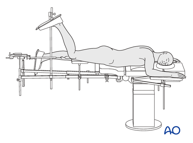 Prone position