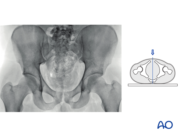 psoas sign x ray