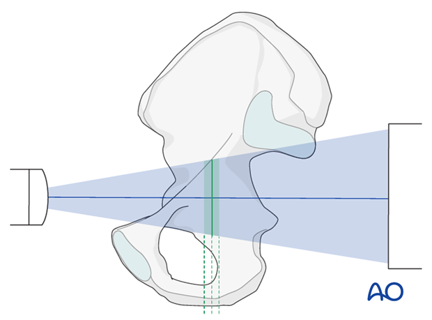 radiology of the intact acetabulum