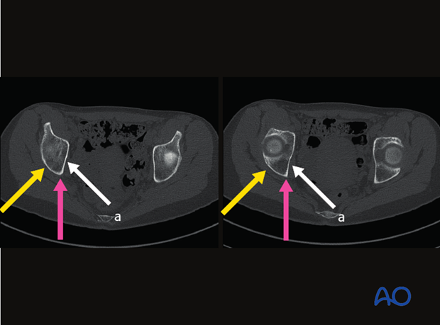 radiology of the intact acetabulum