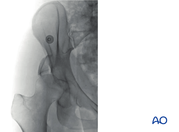 radiology of the intact acetabulum