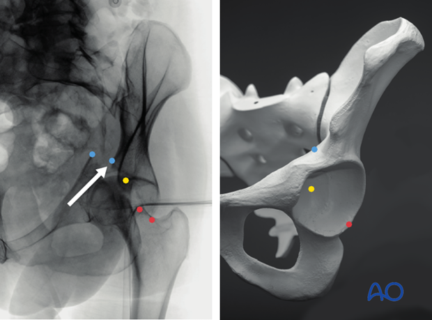 radiology of the intact acetabulum