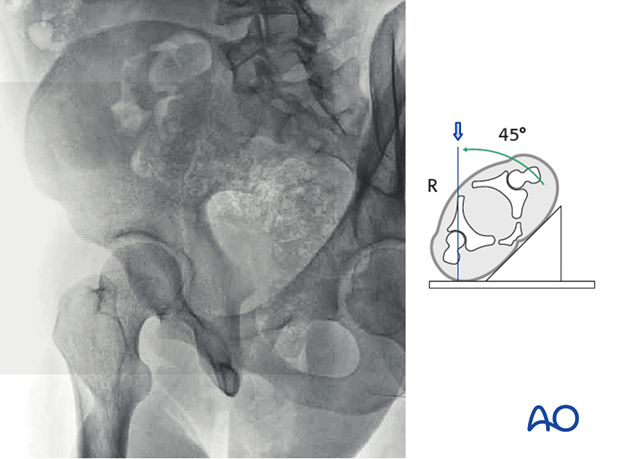 radiology of the intact acetabulum