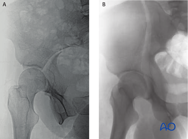 radiology of the intact acetabulum