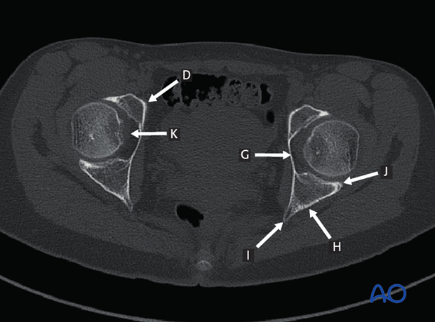 radiology of the intact acetabulum