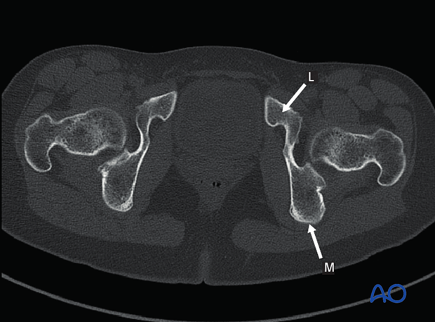 radiology of the intact acetabulum