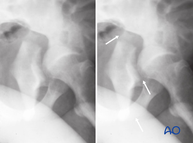 characteristics of elemental fracture types