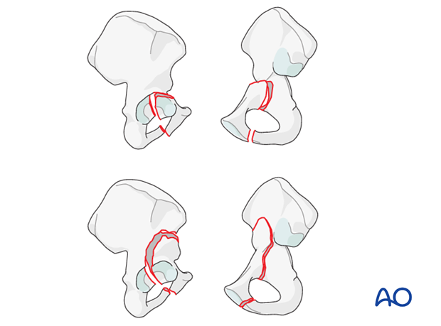 characteristics of elemental fracture types