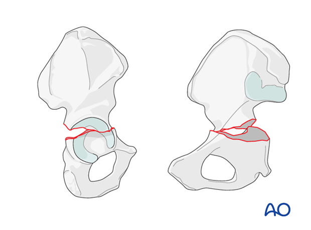 characteristics of elemental fracture types