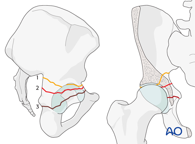 characteristics of elemental fracture types