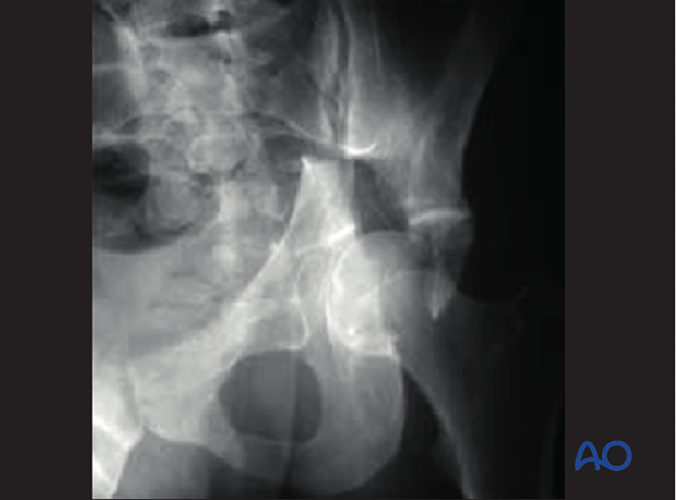 characteristics of elemental fracture types