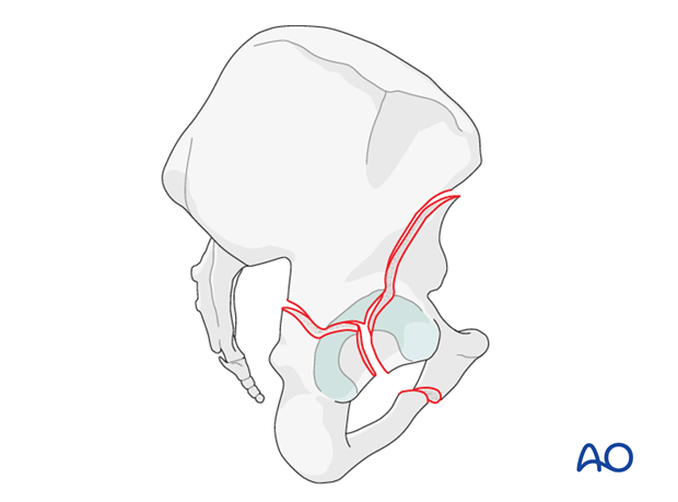 characteristics of associated fracture types