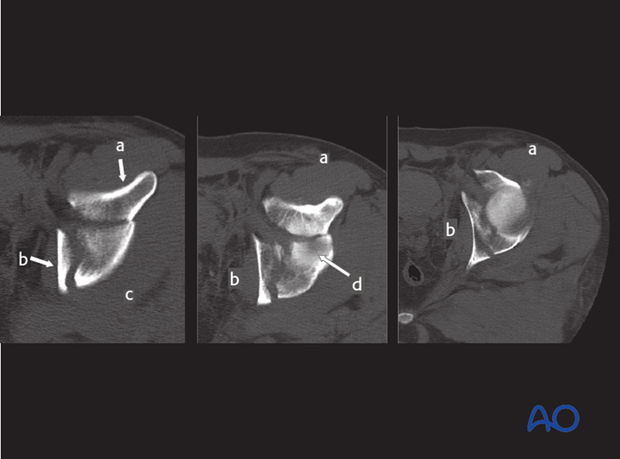 characteristics of associated fracture types