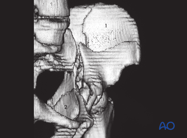 characteristics of associated fracture types