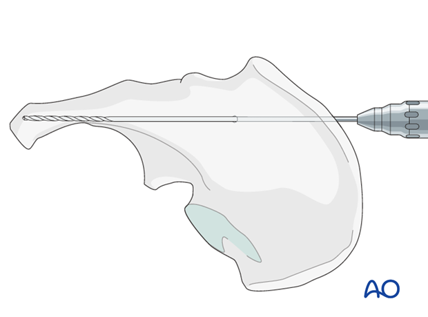 general stabilization principles and screw directions