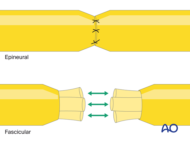 nerve repair technique