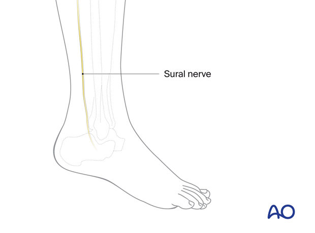 interpositional nerve graft from the sural nerve