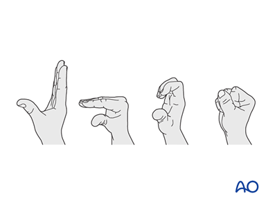 Diminished Hand Sign Digital nerve lesions in the hand