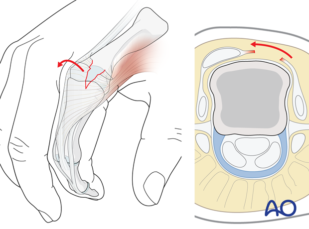 Sagittal band injury at the MCP joint