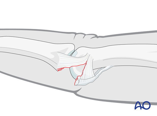 Volar plate injury at the proximal interphalangeal joint