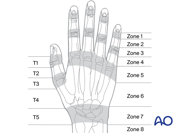 Extensor surface injury zones of the fingers and the thumb