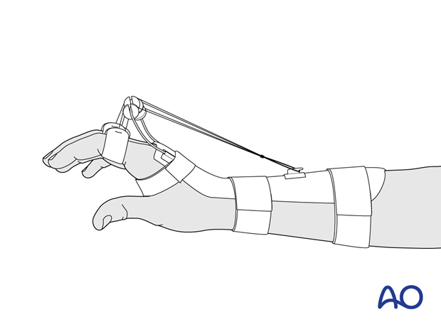 Dynamic splint to protect extensor tendon injuries