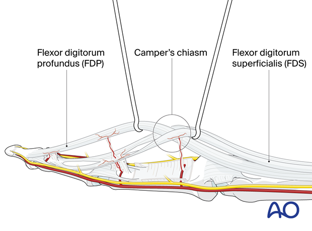 Camper’s chiasm of the flexor digitorum profundus running through the flexor digitorum superficialis at the level of the middle phalanx