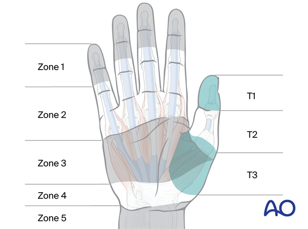 Flexor tendon injury classification: Zones 1–5