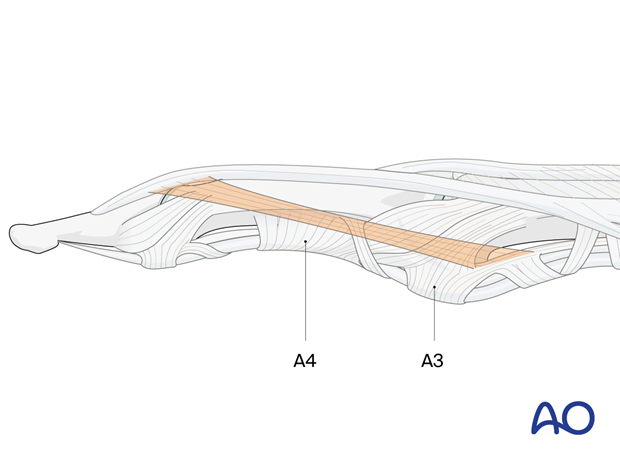 Ligament of Landsmeer