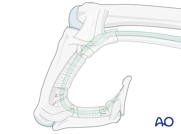 Flexor digitorum profundus flexing the DIP and PIP joints