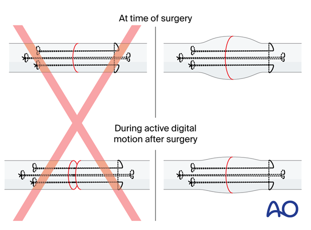 Tendon repair techniques