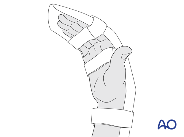 Dorsal blocking splint of the hand and wrist