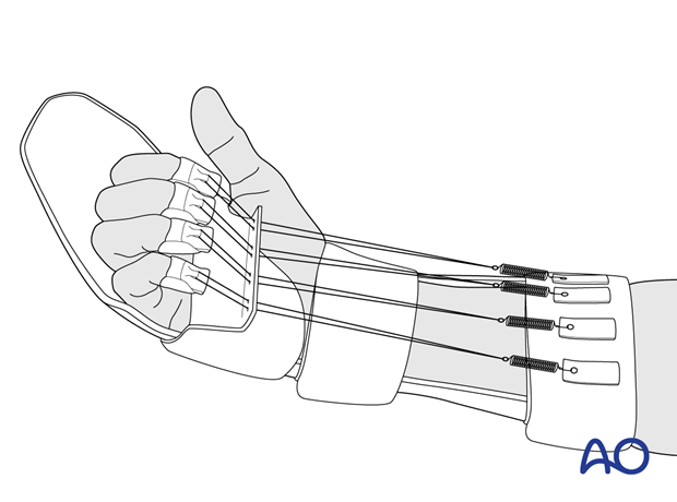 Dynamic splint of the hand for aftercare of flexor tendon injuries