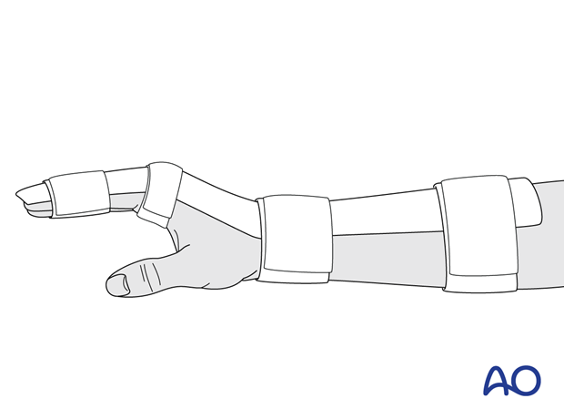 Dorsal splint of the hand and wrist