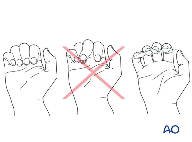 Check the alignment and rotational correction by moving the finger through a range of motion.